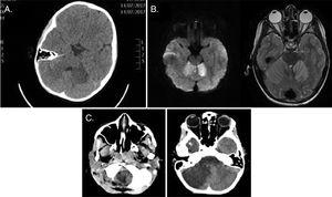 (A) TC craneal. Corte transversal apreciando hipodensidad subcortical en hemisferio cerebeloso izquierdo de aspecto inespecífico. (B) RM cerebral. Corte transversal en secuencia T2 asociando hiperintensidad de ambos hemisferios cerebelosos, con restricción en la difusión y realce cortical tras la administración de contraste. (C) TC craneal. Corte transversal apreciando progresión de las imágenes de isquemia cerebelosa, asociando edema con efecto masa y descenso amígdalas hasta foramen magno, con aumento de la talla ventricular supratentorial.