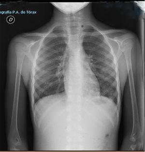 Radiografía de tórax AP, donde se aprecia aumento de densidad inespecífica parabronquial y dudosa dilatación de esófago cervical y torácico (*).