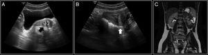 Caso 1. A y B) Ecografía en la que se visualiza útero bicorne (flechas). C) RM donde se objetiva agenesia renal izquierda y riñón derecho compensador, y posible útero bicorne.