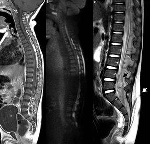RM de columna completa en plano sagital: a) Secuencia T1-contraste que muestra un absceso epidural posterior con compresión medular y distensión vesical (*blanco); b) Secuencia difusión que pone de manifiesto restricción en la colección epidural; c) Secuencia T2 que muestra seno dérmico (flecha blanca), duramadre (flecha negra) y quiste dermoide intradural (*negro).