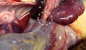 Visión del orificio herniario (círculo) desde la cavidad torácica.D: diafragma; I: intestino; P: pericardio; PI: pulmón izquierdo.