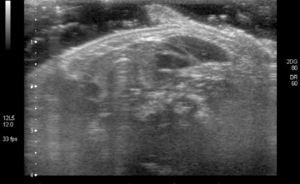 Ecografía cervical: estructura superficial de aproximadamente 10mm con características ecográficas similares al tejido dérmico, situada lateralmente al músculo esternocleidomastoideo que protruye hacia el exterior.