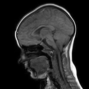 Resonancia magnética nuclear: corte sagital que muestra la herniación de amígdalas cerebelosas compatible con malformación de Arnold-Chiari tipo 1.