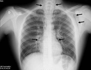 Radiografía posteroanterior donde se observa aire en el mediastino rodeando el corazón y penetrando en el cuello y la axila izquierda (causando el enfisema subcutáneo).