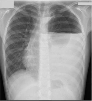 Radiografía de tórax. Gran hidroneumotórax izquierdo con desplazamiento contralateral del mediastino.