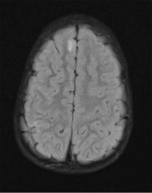RM cerebral con hiperseñal en T2 y FLAIR.
