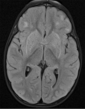 RM cerebral con hiperseñal en T2 y FLAIR.