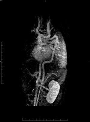 Angio-RMN. Reconstrucción MIP grueso que incluye los trayectos arteriales y venosos de tórax y abdomen. Severa elongación de aorta torácica con cayado distal hipoplásico. Marcadas angulación en aorta ascendente, al inicio de la aorta descendente y en la transición toraco-abdominal. Elongación de los troncos supraaórticos en «tirabuzón» y de las ramas viscerales de aorta abdominal.