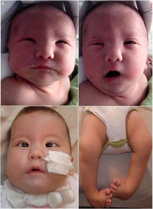 A y B) Recién nacido con parálisis facial bilateral en reposo (A) y durante el llanto (B): A) Se observa cierre incompleto de la comisura palpebral (lagoftalmos). B) La asimetría facial es evidente durante el llanto. Se observa la «cara en máscara» con conservación parcial de la musculatura facial inferior derecha (desviación de la comisura bucal homolateral). C) Mismo paciente de A y B a los 3 meses de vida, con sonda nasogástrica y cánula de traqueotomía. Se evidencia el estrabismo convergente y la implantación baja del pabellón auricular. D) Pie equino varo bilateral.
