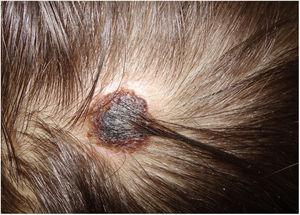Lesión costrosa negra en el cuero cabelludo.