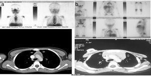 a y b) Imágenes de TC y GA-67 de dos pacientes con hiperplasia tímica de rebote (pacientes 1 y 2 en la tabla 2).