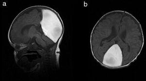 Sagital (a) y axial (b) T1. Lesión hiperintensa en el lugar de la tórcula y el seno recto, con efecto masa sobre la tienda del cerebelo.