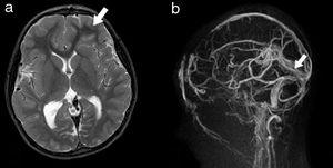 RM a los 8 años. Axial T2 (a): Cierta displasia opercular frontal izquierda (flecha) que ya estaba presente en el nacimiento. Angio-RM venosa (b): Desaparición del hematoma y recanalización del seno recto (flecha) y senos transversos (no se muestra). No existe dilatación ventricular salvo discreta asimetría en astas occipitales, ni alteraciones en parénquima.