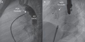 (a) Angiografía en proyección oblicua anterior-derecha que muestra el dispositivo Occlutech PDA Occludder (flecha). La inyección de contraste desde la aorta descendente evidencia la ausencia de shunt residual a través del ductus arterioso persistente. AO DESC: aorta descendente. (b) Fluoroscopia antero-posterior que ilustra el dispositivo de cierre de CIA, Figulla ASD Occluder (flecha) tras ser liberado.