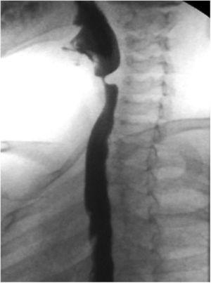 Tránsito esófago-gástrico prequirúrgico: impronta del músculo cricofaríngeo a nivel de la unión faringoesofágica (C4-C5), con paso filiforme del contraste baritado.
