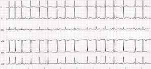 Electrocardiograma caso 2.