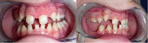 Imagen intraoral en proyección frontal (A) y lateral (B) evidenciando ausencia de múltiples dientes definitivos y presencia de dientes deciduos a los 12 años. Diastemas severos sugestivos de agenesia dental congénita.