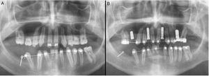 Ortopantomografía en el momento del diagnóstico donde se evidencia la ausencia de múltiples dientes con 15 años (A). Control radiológico posterior al tratamiento mediante implantes dentales y regeneración ósea en cuarto cuadrante oral a los 21 años (B).