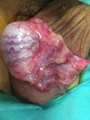 Imagen quirúrgica: se visualiza lesión quística/vascular no infiltrativa adyacente al polo inferior del testículo. La lesión se extirpó quirúrgicamente.