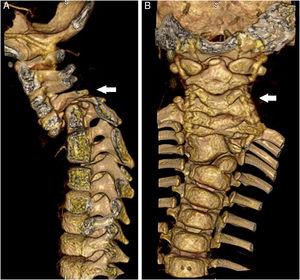 TC de columna cérvico-dorsal (reconstrucción helicoidal) previo a la intervención quirúrgica. A) Plano sagital, luxación anterior de la columna cérvico-dorsal. B) Plano coronal, fusión de los cuerpos vertebrales cervicales.