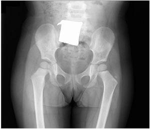 Radiografía anteroposterior de pelvis, sin hallazgos patológicos significativos.