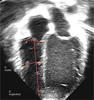 Ejemplo de medición de diámetros ventriculares basal, medial y longitudinal en plano apical de 4 cámaras de forma estandarizada.