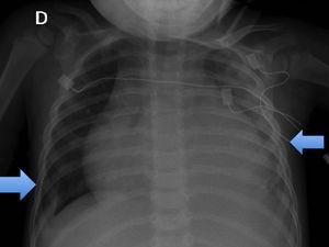 Radiografía posteroanterior de tórax. Destaca importante cardiomegalia con derrame pleural bilateral (señalado con flechas).