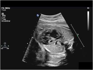 Ecocardiograma prenatal a las 31 semanas de gestación evidenciando ventrículo izquierdo extremadamente infradesarrollado.