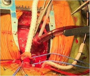 Imagen intraoperatoria de cirugía de Norwood en estadio i de la paliación en paciente con síndrome de corazón izquierdo hipoplásico. Momento en el que se realiza una anastomosis entre una derivación consistente en un tubo reforzado de 5mm aumentado con pericardio heterólogo y la bifurcación de la arteria pulmonar. Colocación de cintas de color azul en las arterias pulmonares nativas. Nótese que el flujo arterial entra a través de una derivación de 3,5mm anastomosada a la arteria innominada, mientras que una cánula venosa única se inserta en la aurícula derecha a través de su apéndice. En este momento, el paciente está siendo enfriado y bajo asistencia ventricular de flujo continuo.
