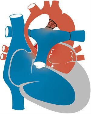 Representación esquemática del procedimiento híbrido para manejo del síndrome de corazón izquierdo hipoplásico.