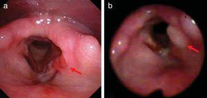 a) Quemosis de ventrículo derecho, erosión e inflamación de hemilaringe izquierda (flecha); b) Persistencia de la inflamación de hemilaringe supraglótica izquierda con zona de fibrina en su parte posterior.