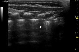 Consolidación subpleural a nivel basal posterior de hemitórax derecho (flecha).