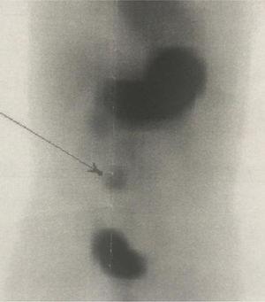 Gammagrafía con tecnecio 99. La flecha indica la captación anormal de la mucosa gástrica ectópica propia del divertículo de Meckel.