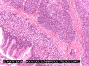 Imagen microscópica de corte histológico con presencia de mucosa yeyunal, glándulas fúndicas y páncreas ectópico, hallados en muestra de tejido de ambos divertículos.