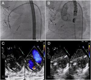 A y B) Liberación del dispositivo con cierre completo del defecto y con permeabilidad de la coronaria derecha distal. C y D) Comprobación del cierre por ecocardiograma transesofágico.