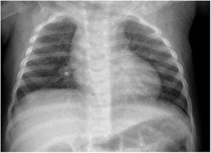 Radiografía de tórax. Imagen radiopaca en zona parahiliar derecha, sin signos de atrapamiento aéreo.