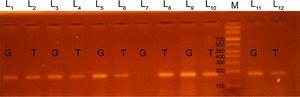Productos de la amplificación del locus rs5370 del gen EDN1 mediante reacción en cadena de la polimerasa (PCR-ARMS) con identificación de los genotipos GT (calles 1-6, 9-12) y TT (calles 7, 8); la calle M corresponde al marcador de peso molecular. L: calle.