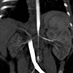 Angio-TC: estenosis de la aorta abdominal y de ambas arterias renales. Riñón derecho pequeño.