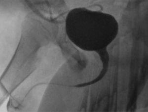 CUMS postoperatoria donde se aprecia la uretra normal tras el tratamiento endoscópico del siringocele.