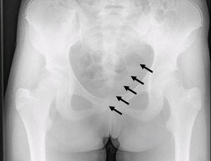 Radiografía simple de pelvis en la que se aprecia una sutil imagen en doble raíl sugestiva de cuerpo extraño, señalada con las flechas.
