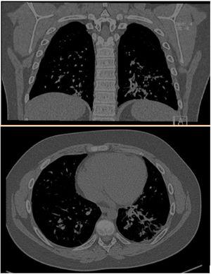 TAC pulmonar corte coronal y axial donde se visualizan signos radiológicos de neumonía organizada.