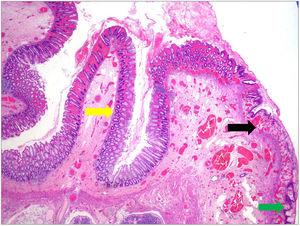 Imagen histológica de la masa extrofiada en la que se identifica epitelio escamoso anal (flecha verde), zona transicional (flecha negra) y mucosa rectal con muscular de doble capa (flecha amarilla) (4x), hallazgos correspondientes al diagnóstico de duplicación anorrectal.