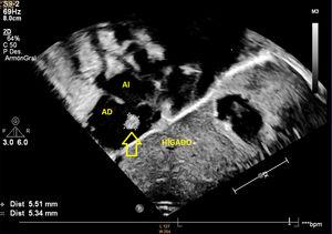Ecocardiograma transtorácico. Imagen subcostal que muestra una imagen hiperecogénica organizada de 5,5 mm x 5,3 mm (flecha) en la aurícula derecha (AD).