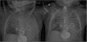 Radiografías realizadas en UCIP antes (izquierda) y después (derecha) de la fibrobroncoscopia.
