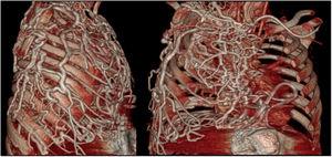 Extensa circulación venosa pulmonar colateral demostrada mediante tomografía computarizada (reconstrucción en 3D) que podría haber condicionado estasis venoso y linfático y secundariamente la formación de moldes bronquiales.