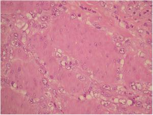 Biopsia (tinción hematoxilina-eosina) que muestra células neoplásicas sugestivas de adenocarcinoma gástrico.