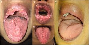 A. Lesiones de aspecto papilomatoso en la mucosa labial, el dorso y la punta de la lengua. Presentaba lesiones similares en las encías, la mucosa yugal y paladar blando y duro. Se descartan lesiones faríngeas o laríngeas por fibrolaringoscopia. B y C. Recidiva con aumento de lesiones en los labios y en la lengua, aunque en menor cuantía y de menor tamaño que previamente a la intervención quirúrgica. D. Regresión completa de las lesiones tras actitud expectante.