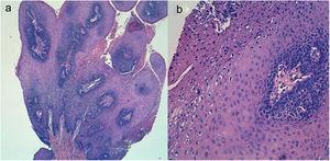 A. Lesión escamosa papilomatosa con severa hiperplasia epidérmica, acantosis y focos de paraqueratosis. B. Binucleación celular y signos de acción viral antigua con balonización del citoplasma.