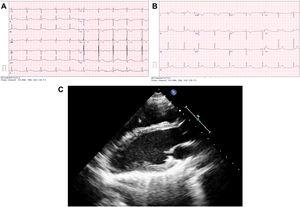 A)ECG basal paciente1. B)ECG basal paciente2. C)Ecocardiografía paciente1. Eje largo que muestra desviación del ápex del ventrículo izquierdo hacia posterior y a la izquierda.