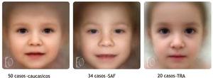 Patrón cráneofacial en controles, niños con síndrome alcohólico fetal (SAF) y niños-TRA.
